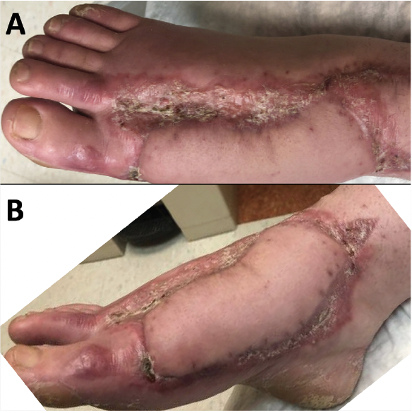 Figure 6. Right foot 8 weeks after  free tissue transfer and split-thickness skin graft. A, dorsal view. B, medial view.