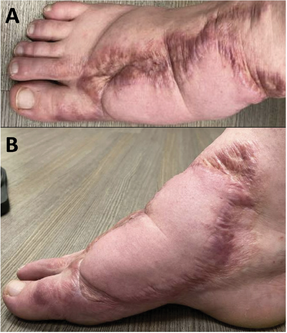 Figure 7. Right foot 29 months after free tissue transfer and split-thickness skin graft. A, dorsal view. B, medial view.