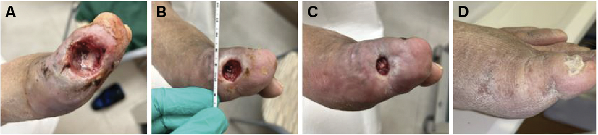 Figure 1. a) Initial presentation b) Week 3 c) Week 5 d) Appearance upon healing.