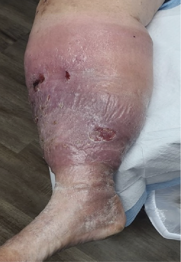 Figure 2. Ulcerative PG, commonly impacting the legs, starts with small, but then widening pustules or blisters. 