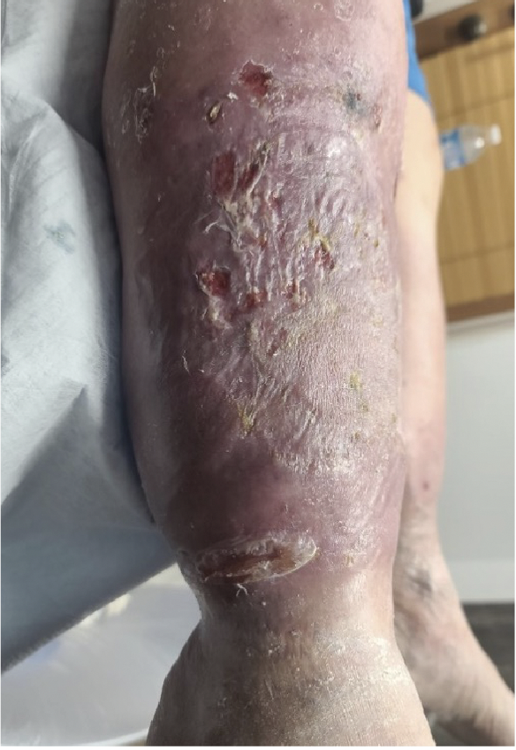 Figure 3. There is no set standard treatment for PG, thus the overall goals include halting the inflammatory cycle.   