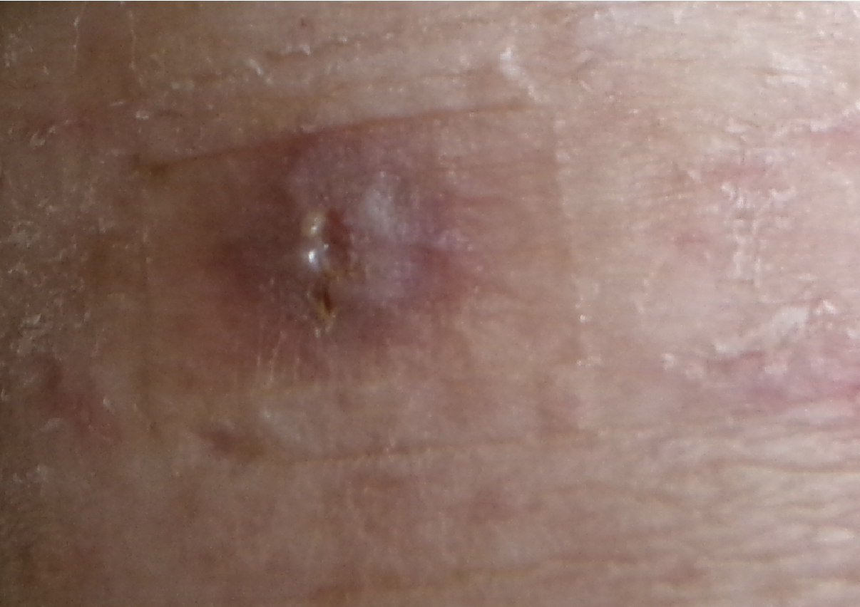 Figure 1. The photo above shows the site of concern during a follow-up post-biopsy. The treating podiatrist referred the patient for Mohs evaluation based on the results. 