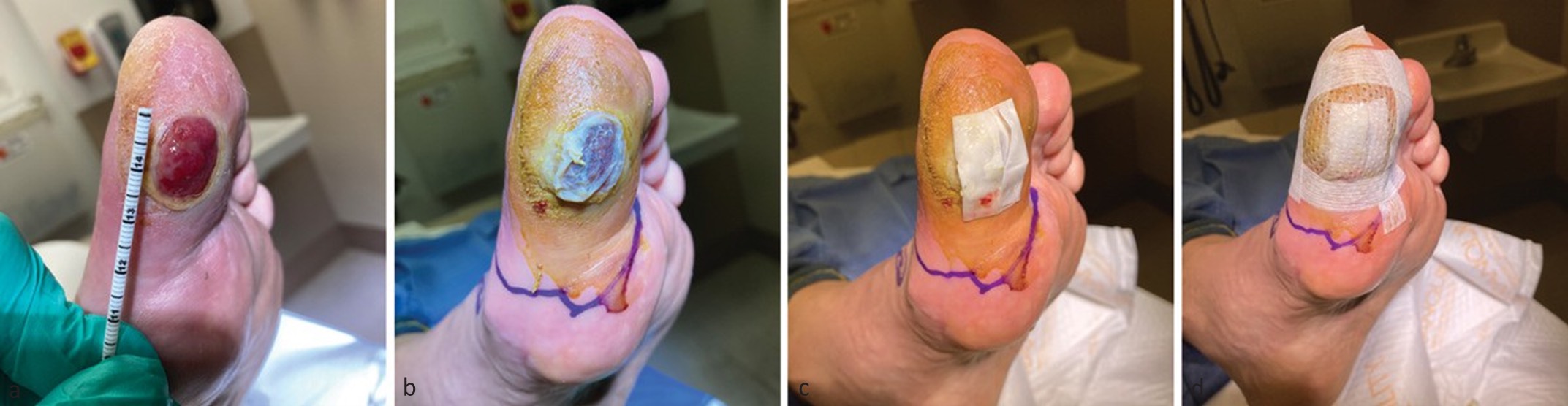 Figure 1. Sequential clinical images of a representative ulcer treated with combination amniotic allograft and synthetic extracellular matrix therapy, demonstrating baseline appearance, post-debridement preparation, graft application, and secured dressing.