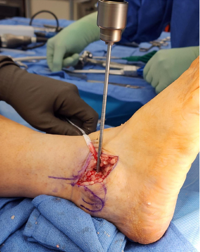Figure 1. Chrisman-Snook lateral ankle reconstruction of ATFL with semitendinosus allograft anchored in talus and fibula reaming.