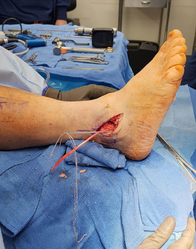 Figure 2. Chrisman-Snook lateral ankle reconstruction of CFL with semitendinosus allograft anchored in the fibula and calcaneus remaining.