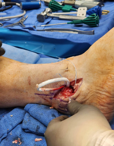 Figure 3. Chrisman-Snook lateral ankle reconstruction with semitendinosus allograft passage.