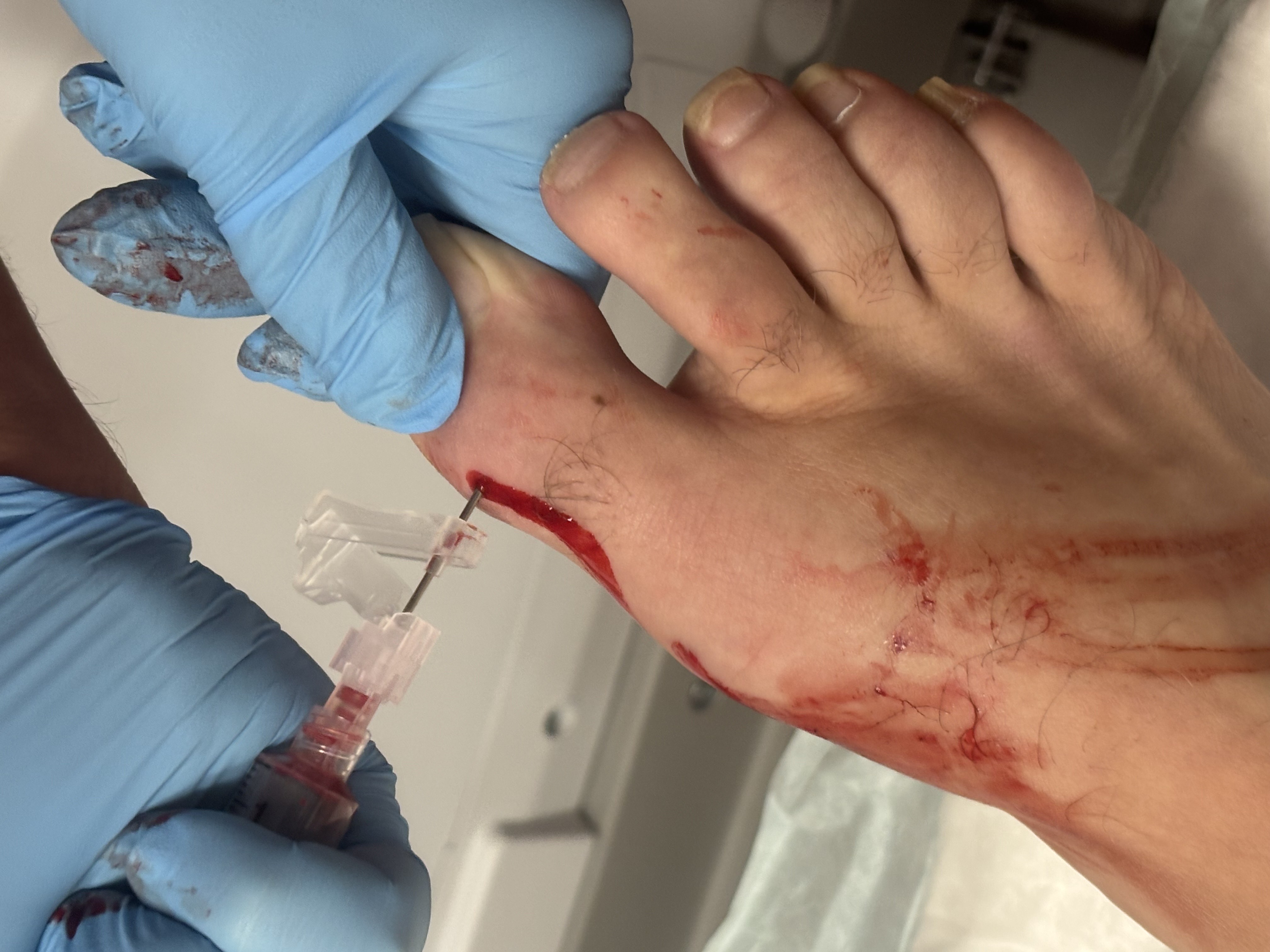 Figure 1. This photo depicts the initial joint aspiration.