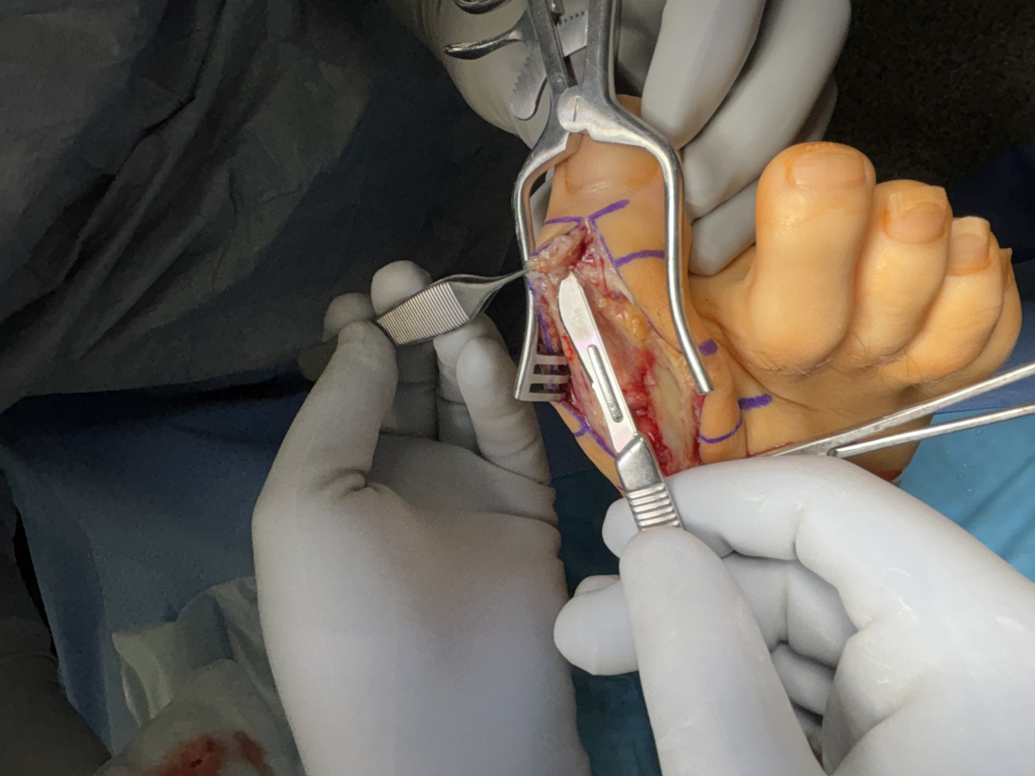 Figure 2. This intraoperative photo shows the findings at the first MTPJ.