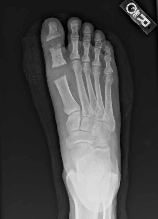 Figure 3. In this postoperative radiograph, one can note the described joint resections.