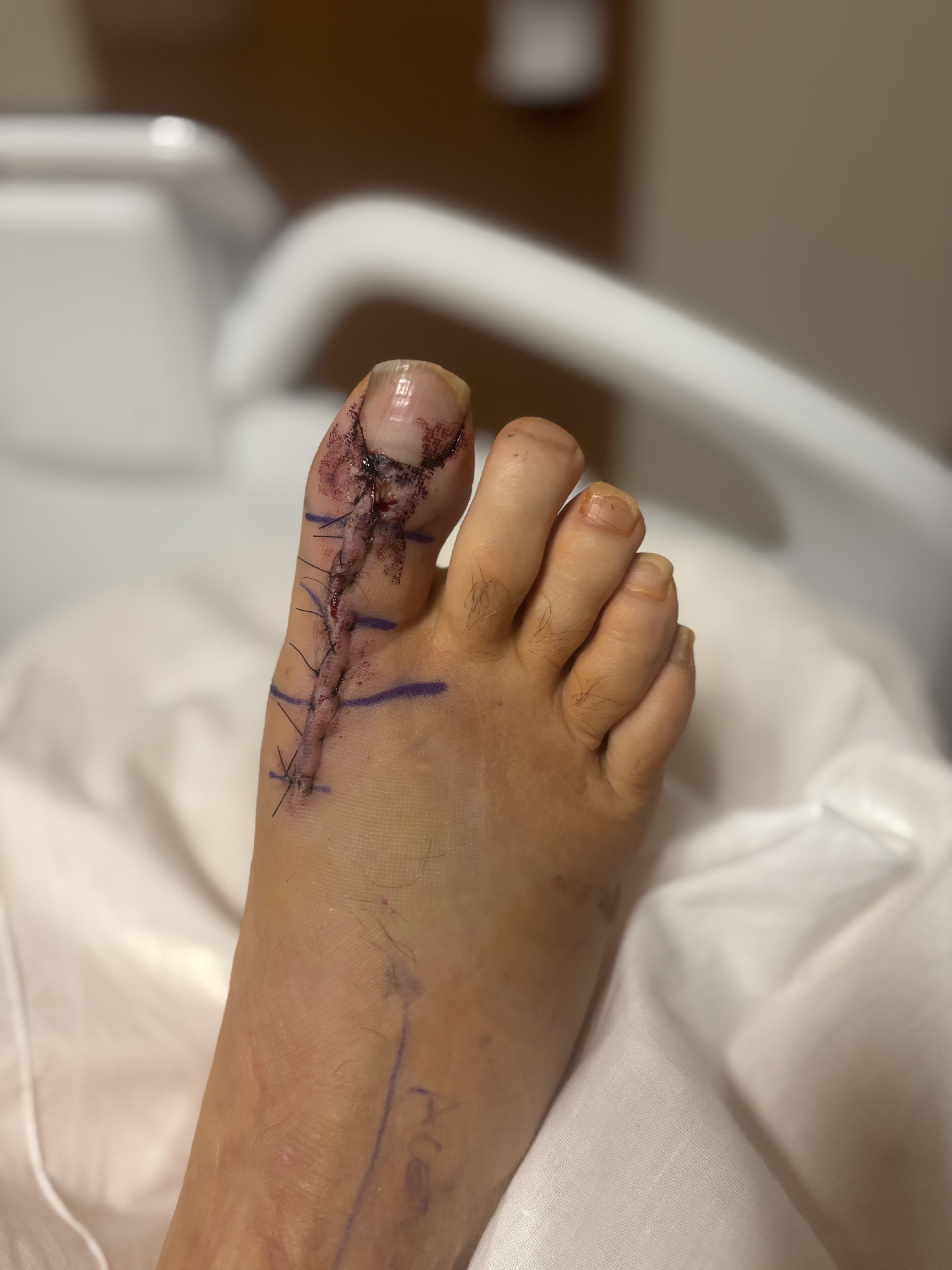 Figure 4. Appearance at one week postoperative.