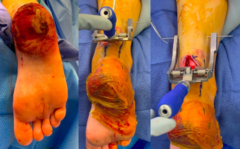 Figure 2. Achilles tendon imbrication using the percutaneous Achilles tendon repair system, with suture insertion into the distal medial and lateral posterior calcaneus.