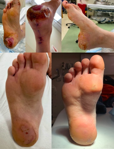 Figure 3. Clinical follow up photos at last follow up of a 43-year-old patient with uncontrolled insulin-dependent type 2 diabetes mellitus and multiple other comorbidities from one week (upper left) to 12 months (bottom right). 