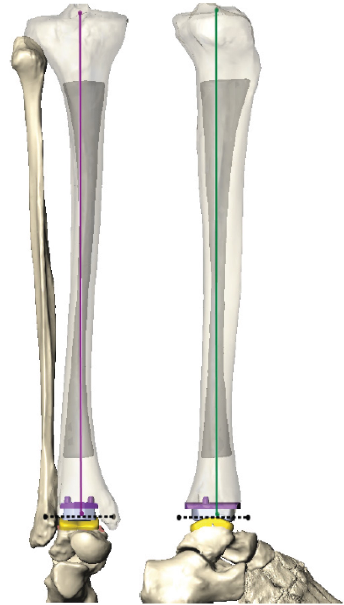 Figure 2. Example of PSI plan alignment based on mechanical alignment of the leg.