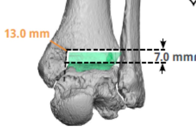 Figure 3. Example of PSI plan highlighting medial malleolar thickness.