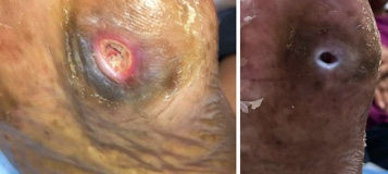 Figure 1a. DFU at presentation with rolled epithelial borders, fibrogranular wound base, and involvement to the level of the subcutaneous tissue. 