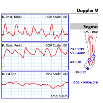 Figure 2. Right lower extremity arterial duplex demonstrates significant mural calcification of the tibial arteries of the right calf with occlusion of the right posterior tibial artery in the proximal calf and the right anterior tibial and peroneal arteries in the distal calf.