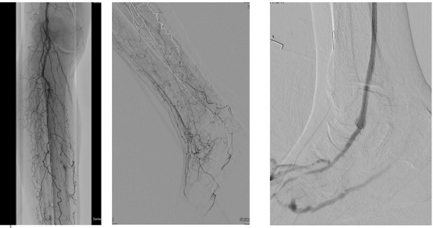Figure 3. Diagnostic angiogram demonstrating severe tibial disease not amenable to endovascular interventions. No bypass target available.