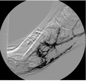 Figure 4. Completion angiogram performed demonstrating arteriovenous connection and engorgement of venous system status post SVA. 