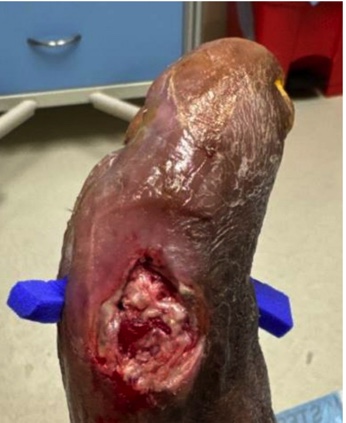 Figure 5a. Right foot with post-surgical wound dehiscence after sesamoidectomy.