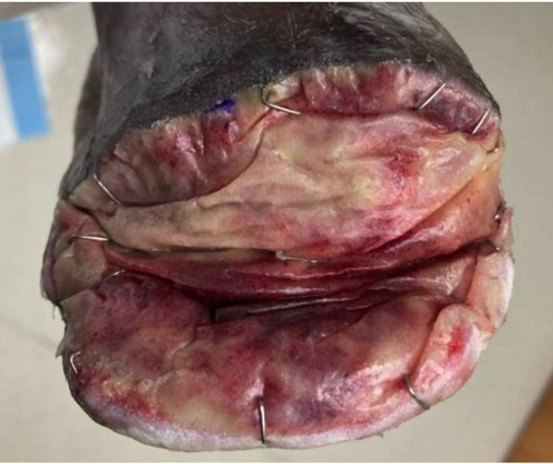 Figure 5b. Right foot TMA with biodegradable temporizing matrix application over deep muscle, fascia, and bone.