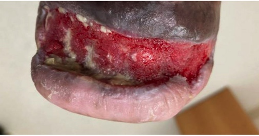 Figure 5c. Two months status post-SVA with granulation tissue visible and start of wound contracture. 