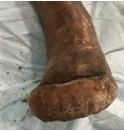 Figure 5d. Five months status post-SVA with complete epithelialization noted. 