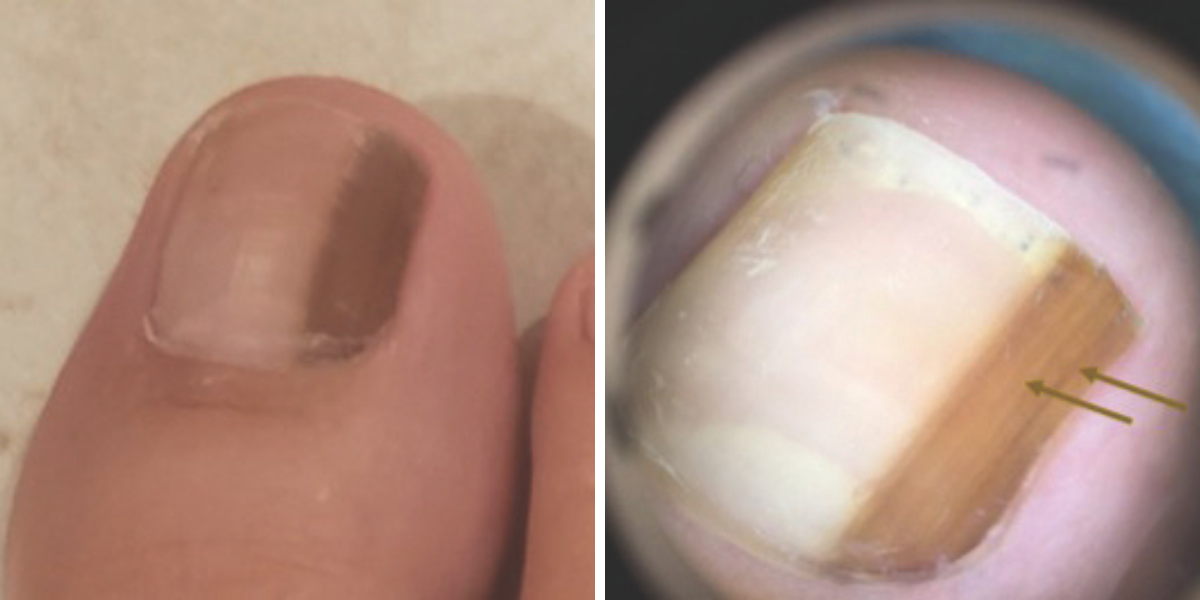 Figures 2–3. The photo on the left shows the clinical appearance of a lesion of longitudinal melanonychia that exhibits irregular dermoscopic features. The dermoscopic photo on the right shows the irregular lesion pattern. Varying shades of pigment in the individual lines are evident, and dictated the decision to refer for biopsy. The biopsy revealed an atypical melanocytic lesion, resulting in a recommendation for complete excision. (Figure 3 courtesy of Dana Stern, MD)