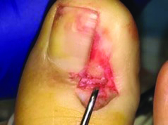 Figure 7. This photo shows the transverse shave procedure for the lesion shown in Figures 2 and 3. The clinician reflects the proximal nail fold and removes the local area of nail plate. The visible, white glistening area is the nail matrix where one performs the shave biopsy. The slice of tissue is so thin that one can actually see the 15-blade through it. 