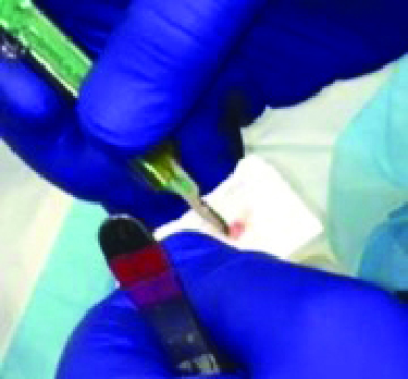 Figure 8. One can see in this photo a small piece of matrix tissue being spread over a small piece of cardboard prior to placement in formalin. This must be done to prevent curling of the tissue upon itself so it can be properly accessed in the pathology lab and prepared for processing. 