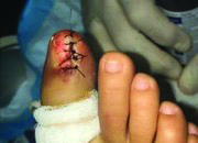 Figure 9. This photo shows an immediate postoperative site of the same patient seen in Figures 1–3 and 7–8. In this particular case, the final pathology revealed an atypical melanocytic process so a Winograd-type resection of the nail fold sufficed to remove the entire lesion. 