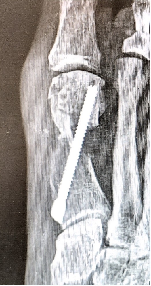 Figure 1. An example of a Type 2 metatarsal explosion.