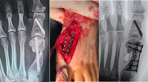 Figure 2 A, B, C. A patient who unfortunately suffered a non-union. at 13. 2A. A postoperative AP radiograph demonstrating a MIS bunion correction with a single screw technique.&nbsp;2B. Intraoperative view post-debridement of non-viable bone and tissue,&nbsp;and application of a autogenous tri-cortical bone graft harvested from the calcaneus and application of a dual plate construct. 2 C. Intraoperative fluoroscopic image demonstrating the autogenous bone graft and dual plating of the first metatarsal nonunion.&nbsp; 