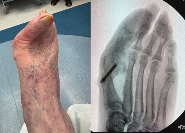Figures 3 A, B, C, D. The images depict the case of an elderly female who previously underwent a MIS bunion surgery. Unfortunately, she experienced a recurrent HAV and painful proximal hardware medially (Figures 3 A, B). 