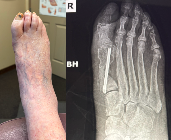 Figures 3 A, B, C, D. The images depict the case of an elderly female who previously underwent a MIS bunion surgery. Unfortunately, she experienced a recurrent HAV and painful proximal hardware medially (Figures 3 A, B). She subsequently underwent hardware removal and revisional MIS bunion surgery (Figure 3 C, D).