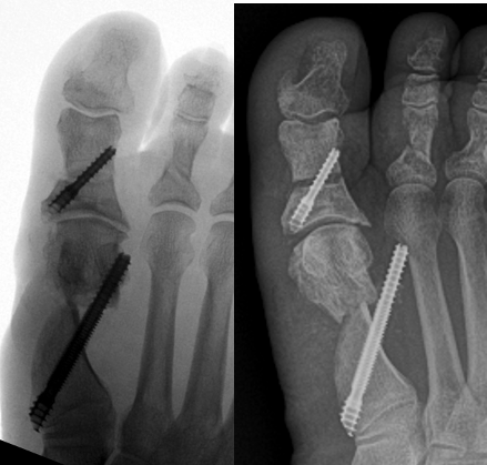 Figure 4 A & B. An example of a metatarsal head disengagement where the screw ends up pulling through the lateral cortex causing loss of correction. Patient may experience pain of the screw rubbing up against the second metatarsal.
