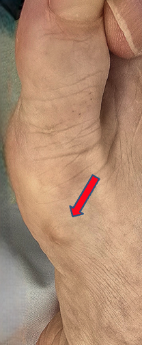 Figure 5.&nbsp;Painful ectopic bone formation associated with MIS bunion surgery which may be confused with a pseudobunion. The patient presents with identical symptoms of a pseudobunion despite normal radiographs.