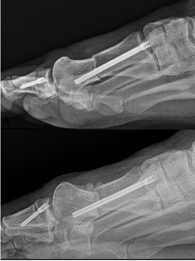 Figure 6 A. Four weeks post-op displaying latent dorsal head displacement. Figure 6 B. Twelve weeks post-op displaying latent dorsal head displacement. 