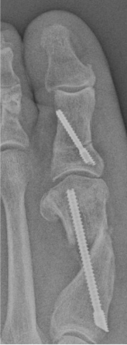 Figure 6 C. Four 4 weeks post-op. 