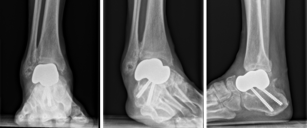 Figure 1. Preoperative plain film imaging demonstrated intact hardware with slight lateral deviation, implant tilt, medial tibiotalar joint space narrowing, varus deformity, and degenerative changes in both the tibiotalar and subtalar joints