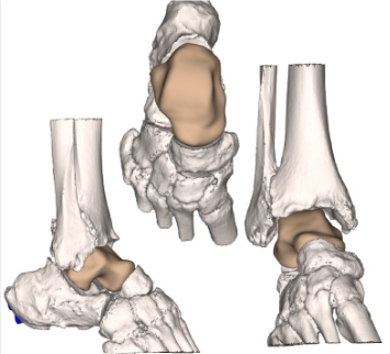 Figure 3. A 3D model with prototype images assisted with preoperative planning.