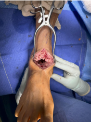 Figure 4. Inspection of the surrounding soft tissue revealed metallic debris consistent with metallosis reaction.