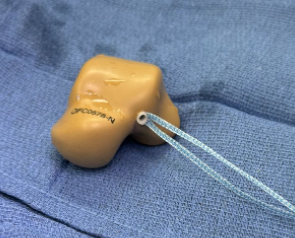 Figure 5. Using a power drill, we installed an Arthrex InternalBrace onto the lateral talar process of the nominal 3D talus implant.
