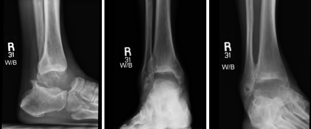 Figure 8. Postoperatively, radiographs and CT scans confirm proper alignment of the PEKK implant without any varus malalignment and adequate positioning.