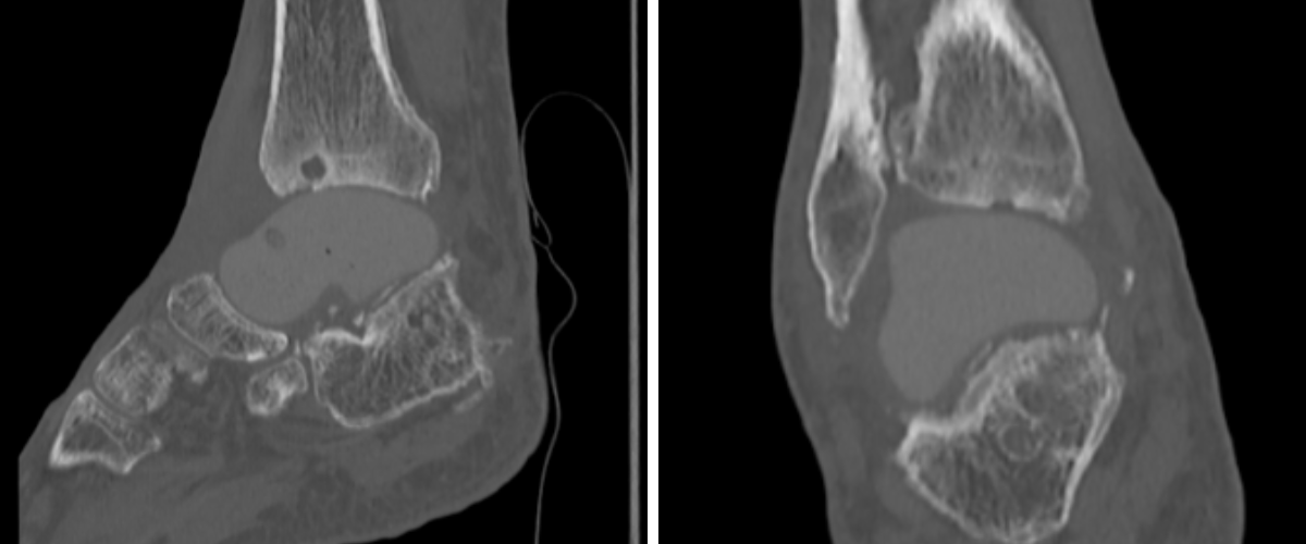 Figure 9. Postoperatively, radiographs and CT scans confirm proper alignment of the PEKK implant without any varus malalignment and adequate positioning.