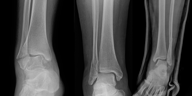 Figure 1. From left to right: Weber A, Weber B, and Weber C ankle fractures.