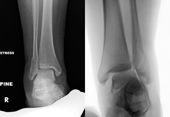 Figure 2. Stress negative (left) and stress positive (right) radiographic images of Weber B ankle fractures.