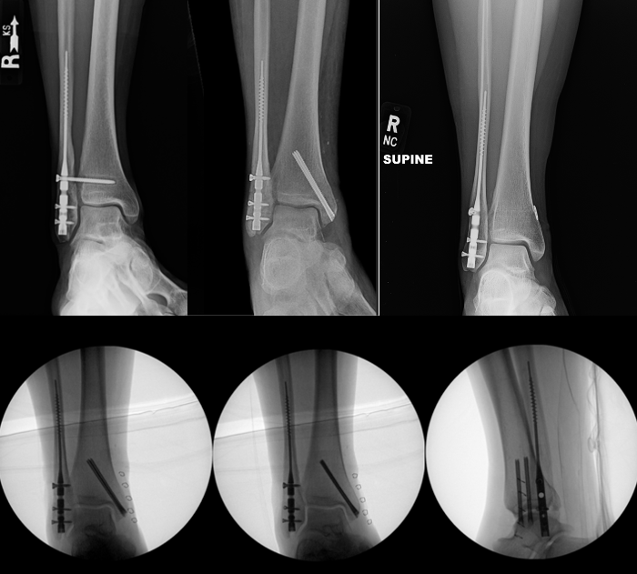 Figure 3. Ankle fractures fixated with fibular nailing. Top row from left to right: Fibular nail with syndesmotic screw, fibular nail with medial malleolus screws and no syndesmotic fixation, fibular nail with suture button syndesmotic fixation. Bottom row: intraoperative fluoroscopic images of fibular nail with medial malleolar fixation. 