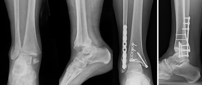 Figure 4. Trimalleolar ankle fracture preoperative films (left) and postoperative fixation (right).