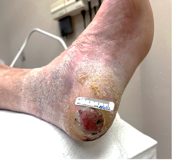 Figure 2. Melanoma masquerading as chronic heel ulceration.