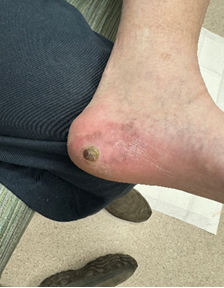 Figure 3. Initial clinical presentation of a brown crusted lesion of 2 months duration, eventually diagnosed as melanoma.